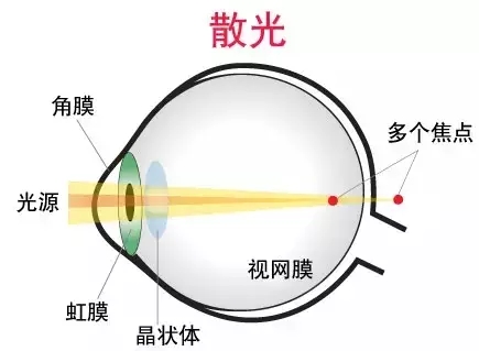 你的眼睛為什么會(huì)散光？